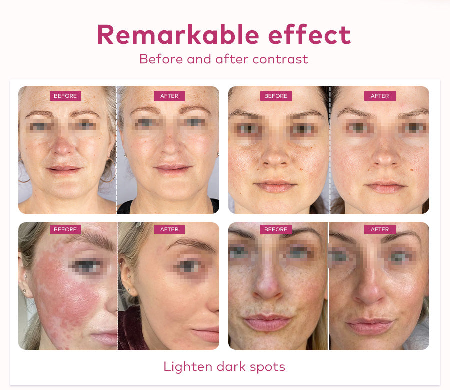 red light therapy rosacea before and after